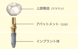 インプラントの構造