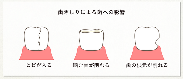 歯ぎしりによる歯への影響