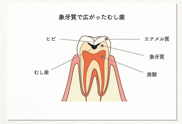 象牙質で広がったむし歯